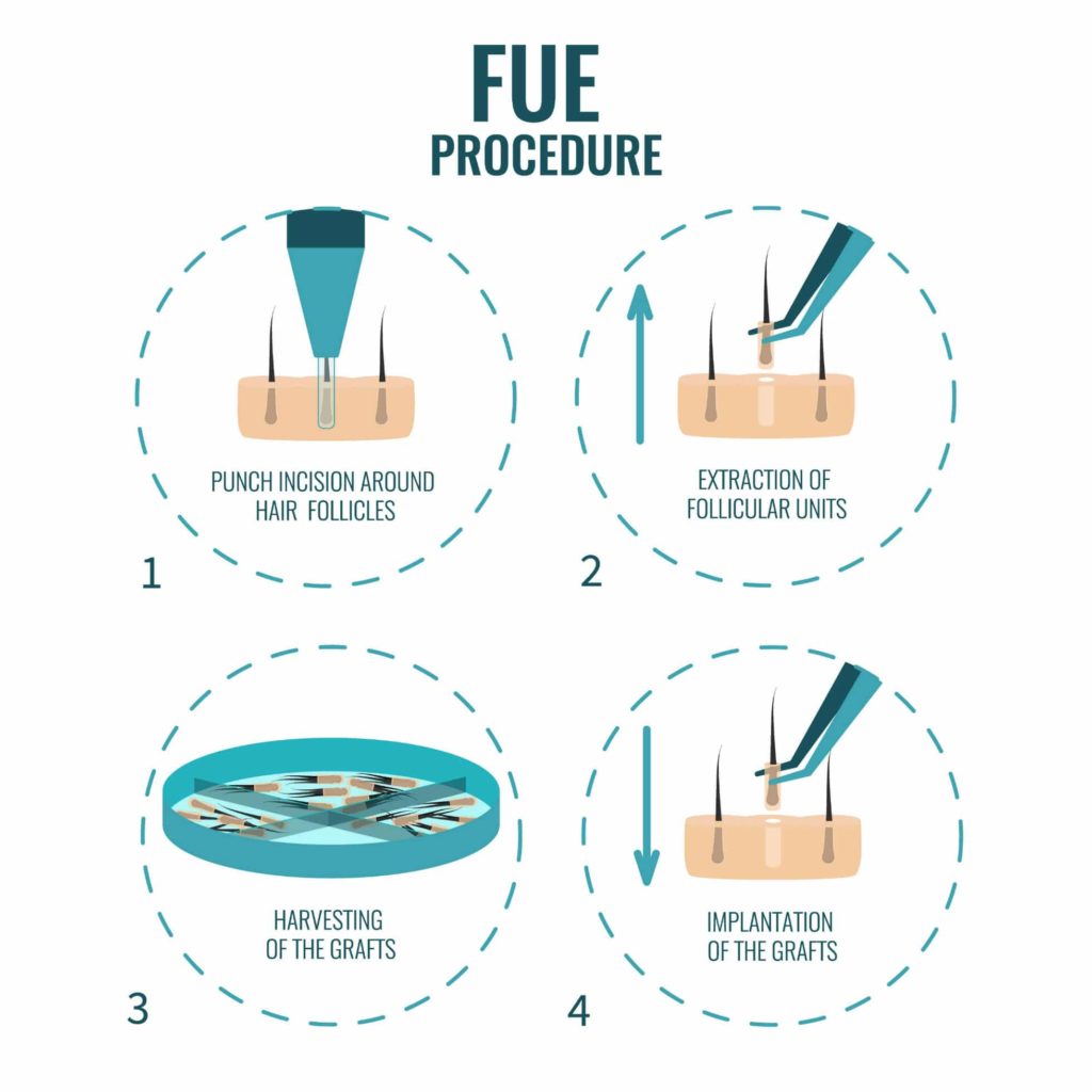 FUE Process