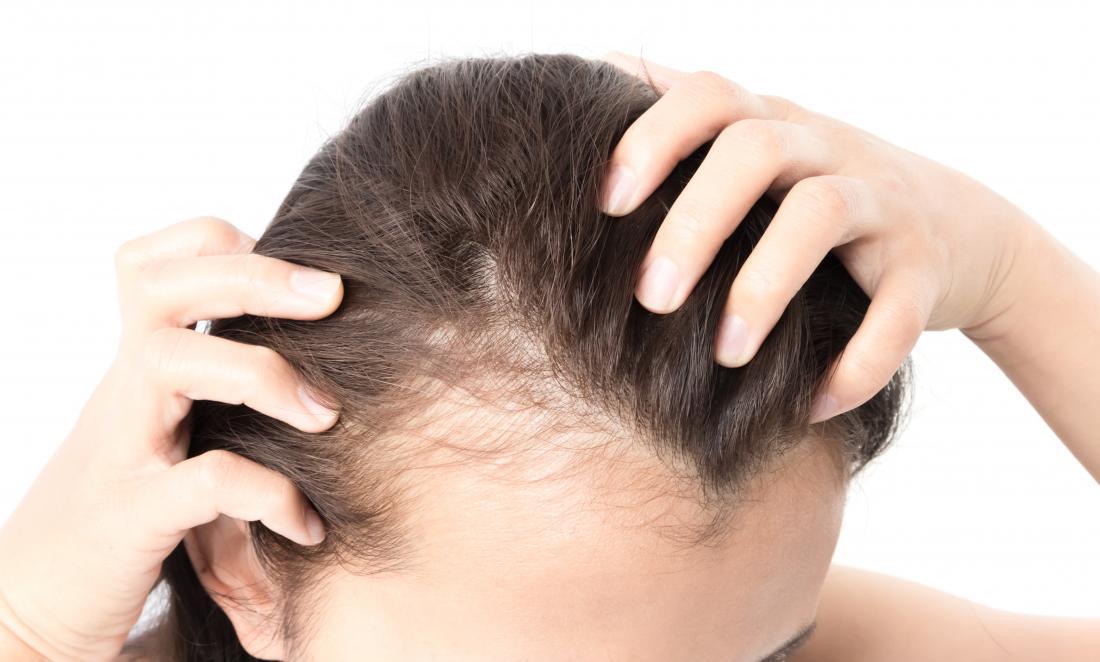 Women Getting Hair Loss Symptoms