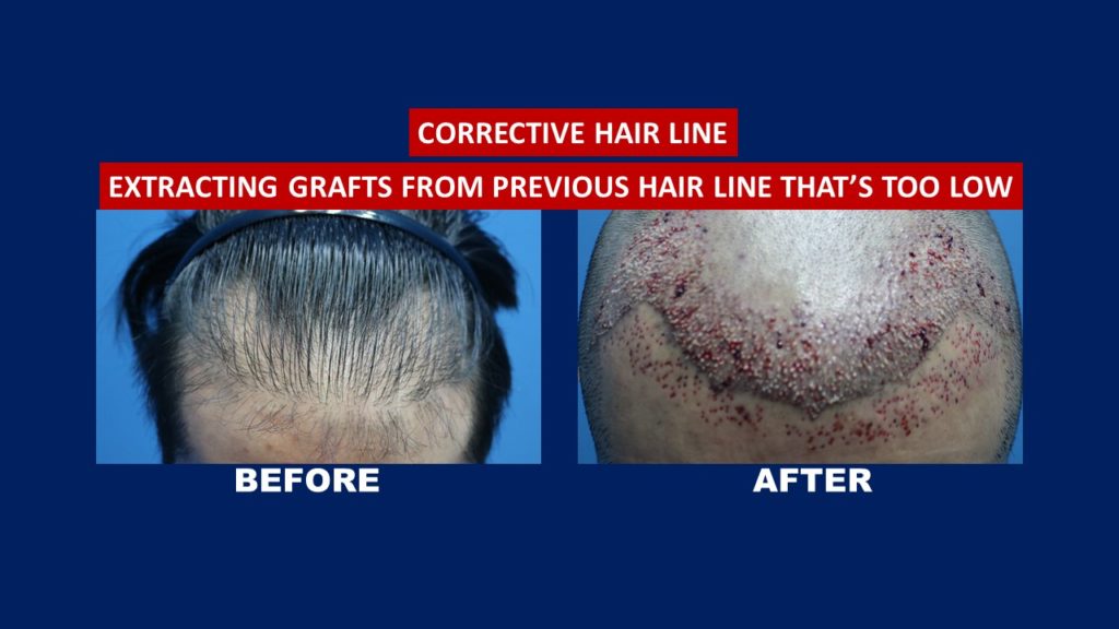 Before and after result for corrective hair transplant services treatment