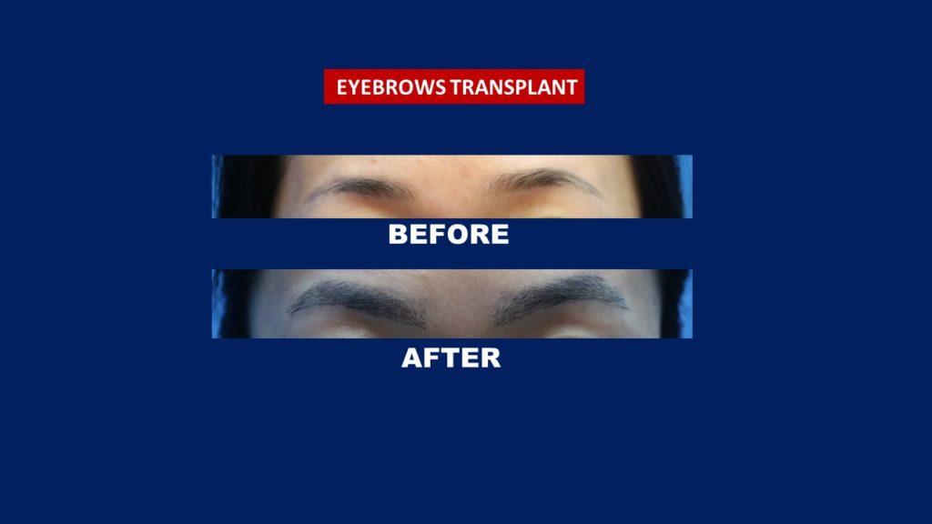 eyebrow transplant treatment services